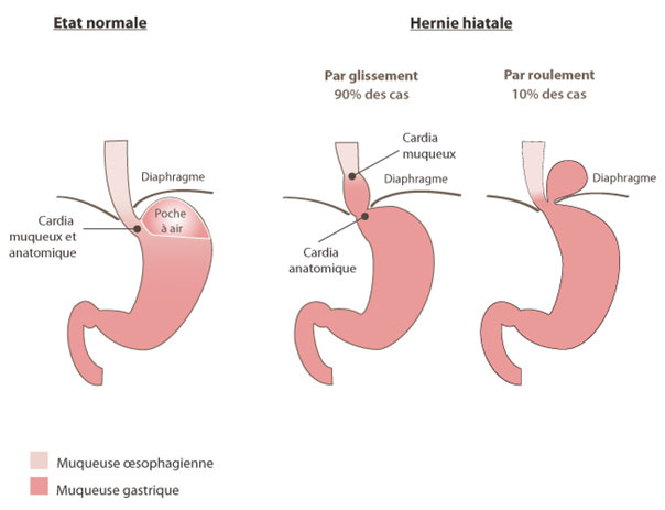 hernier hiatale