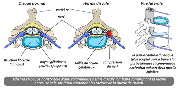 hernie discale soigne en étiopathie