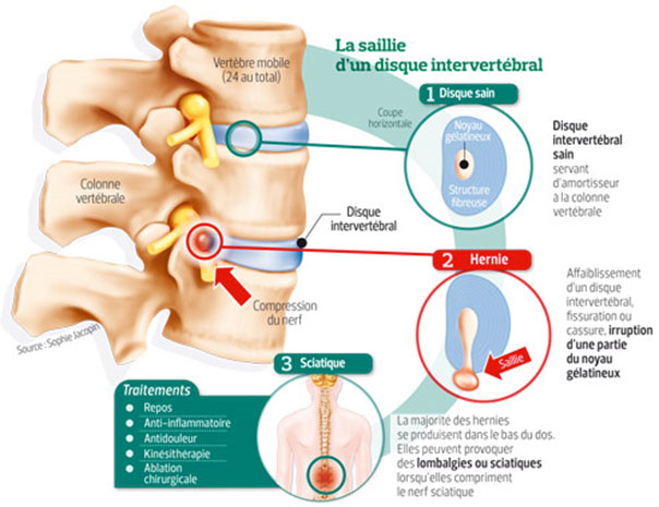 hernie discale soulagé par l'etiopathie