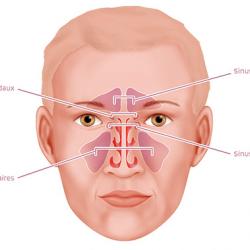 Sinusite - Cause, symptômes, traitement